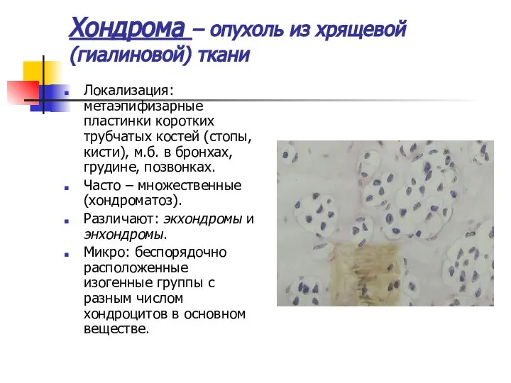 Хондрома – опухоль из хрящевой (гиалиновой) ткани Локализация: метаэпифизарные пластинки коротких