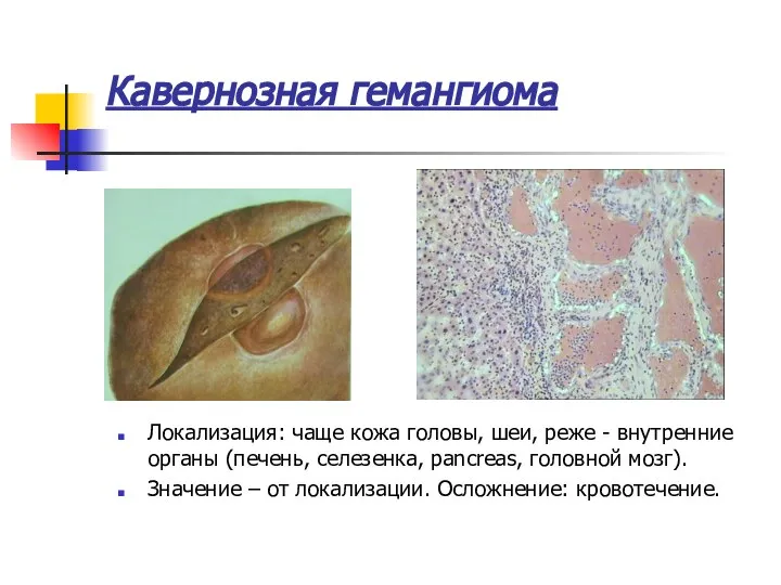 Кавернозная гемангиома Локализация: чаще кожа головы, шеи, реже - внутренние органы