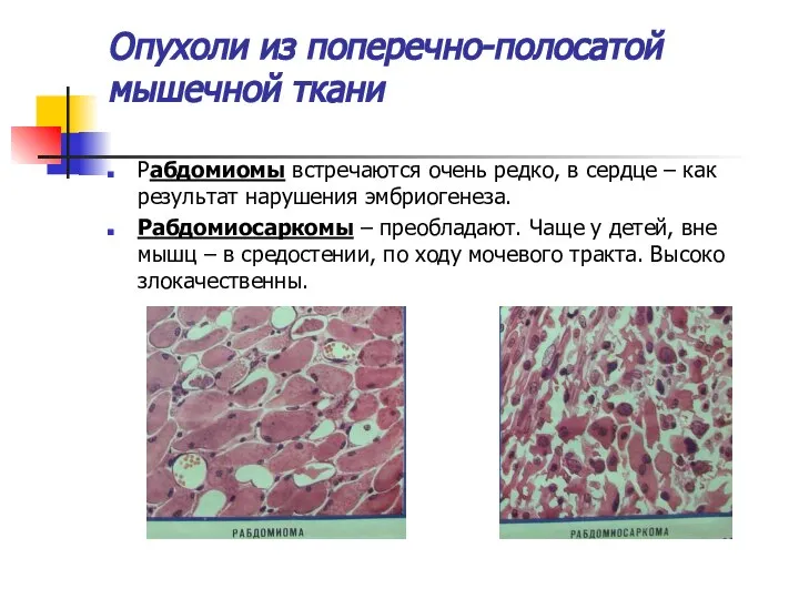 Опухоли из поперечно-полосатой мышечной ткани Рабдомиомы встречаются очень редко, в сердце
