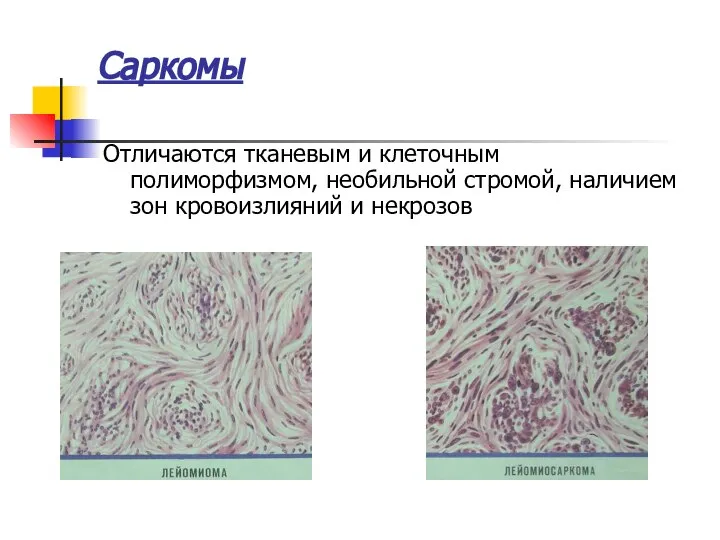Саркомы Отличаются тканевым и клеточным полиморфизмом, необильной стромой, наличием зон кровоизлияний и некрозов