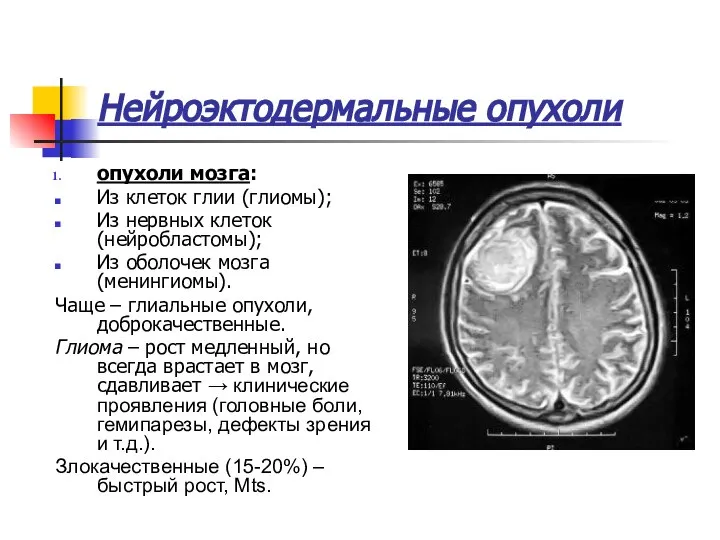 Нейроэктодермальные опухоли опухоли мозга: Из клеток глии (глиомы); Из нервных клеток