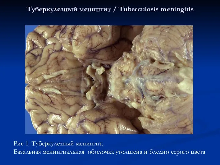 Туберкулезный менингит / Tuberculosis meningitis Рис 1. Туберкулезный менингит. Базальная менингиальная