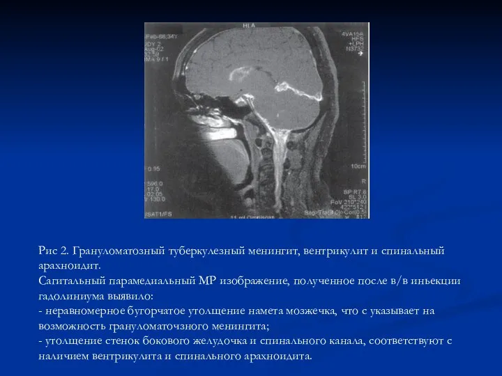 Рис 2. Грануломатозный туберкулезный менингит, вентрикулит и спинальный арахноидит. Сагитальный парамедиальный