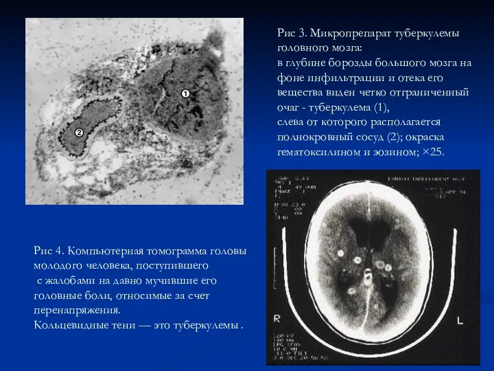 Рис 3. Микропрепарат туберкулемы головного мозга: в глубине борозды большого мозга