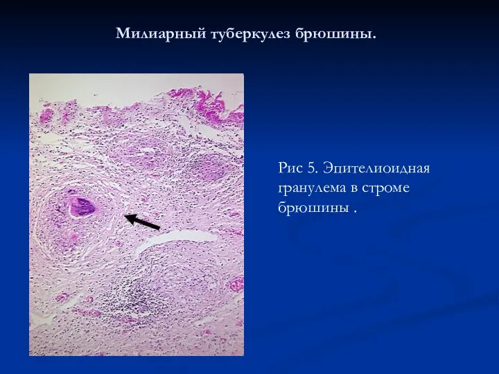 Милиарный туберкулез брюшины. Рис 5. Эпителиоидная гранулема в строме брюшины .