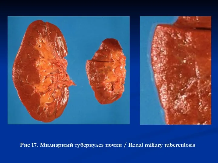 Рис 17. Милиарный туберкулез почки / Renal miliary tuberculosis