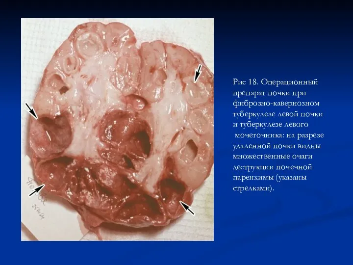 Рис 18. Операционный препарат почки при фиброзно-кавернозном туберкулезе левой почки и