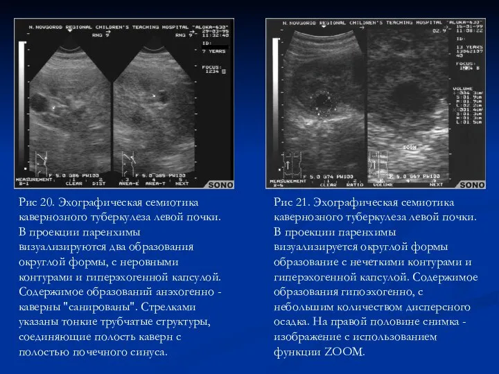 Рис 20. Эхографическая семиотика кавернозного туберкулеза левой почки. В проекции паренхимы