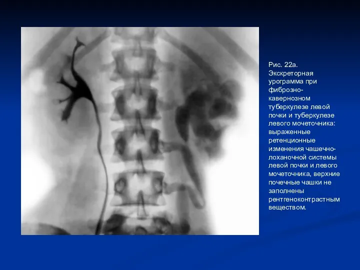 Рис. 22а. Экскреторная урограмма при фиброзно-кавернозном туберкулезе левой почки и туберкулезе