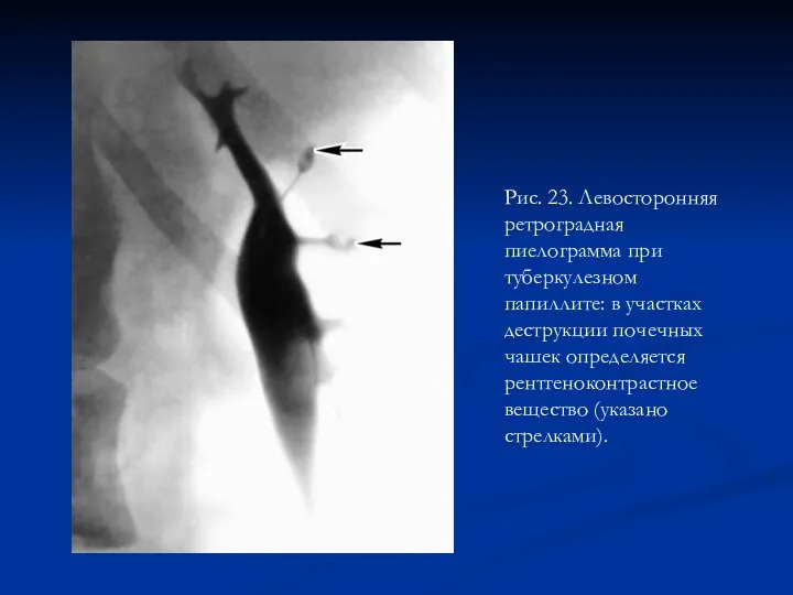 Рис. 23. Левосторонняя ретроградная пиелограмма при туберкулезном папиллите: в участках деструкции