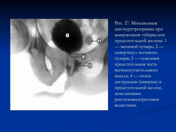 Рис. 27. Микционная цистоуретрограмма при кавернозном туберкулезе предстательной железы: 1 —