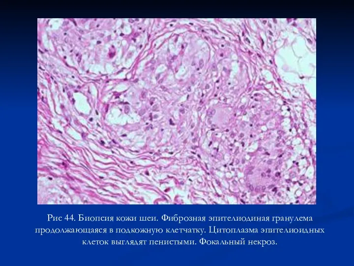 Рис 44. Биопсия кожи шеи. Фиброзная эпителиодиная гранулема продолжающаяся в подкожную