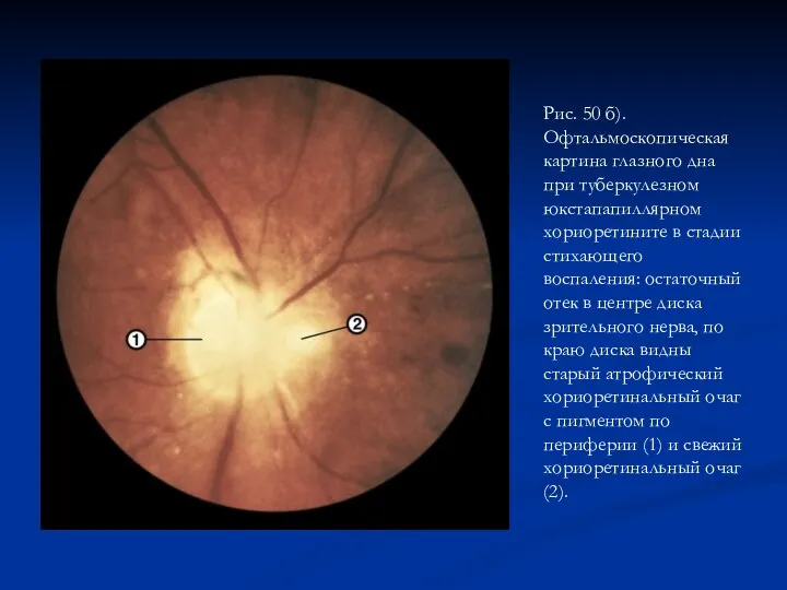 Рис. 50 б). Офтальмоскопическая картина глазного дна при туберкулезном юкстапапиллярном хориоретините