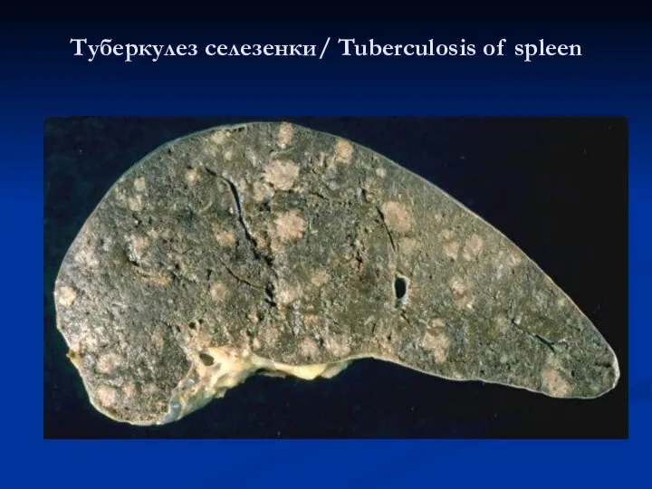 Туберкулез селезенки/ Tuberculosis of spleen