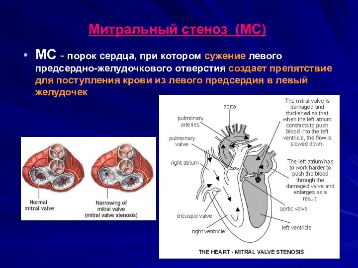 Митральный стеноз (МС) МС - порок сердца, при котором сужение левого