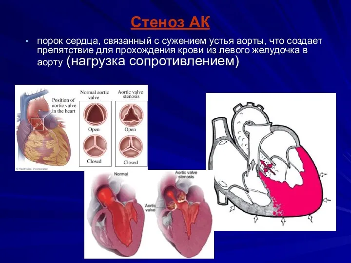 Стеноз АК порок сердца, связанный с сужением устья аорты, что создает