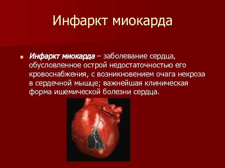Инфаркт миокарда Инфаркт миокарда – заболевание сердца, обусловленное острой недостаточностью его