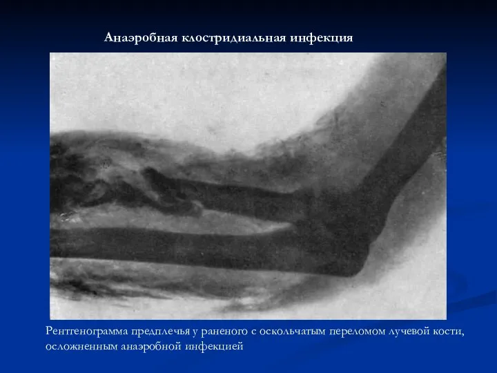 Рентгенограмма предплечья у раненого с оскольчатым переломом лучевой кости, осложненным анаэробной инфекцией Анаэробная клостридиальная инфекция