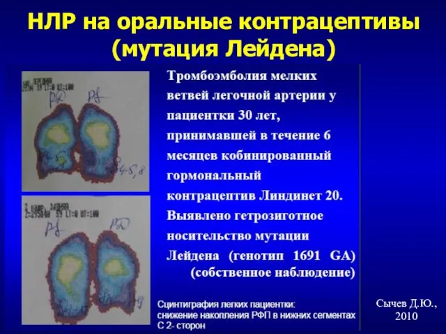 НЛР на оральные контрацептивы (мутация Лейдена) Сычев Д.Ю., 2010