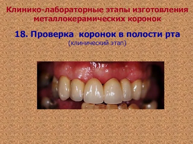 18. Проверка коронок в полости рта (клинический этап) Клинико-лабораторные этапы изготовления металлокерамических коронок