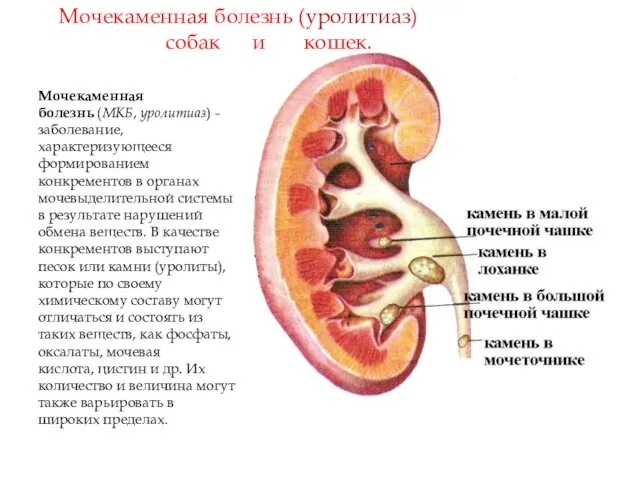 Мочекаменная болезнь (МКБ, уролитиаз) - заболевание, характеризующееся формированием конкрементов в органах