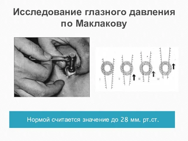 Исследование глазного давления по Маклакову Нормой считается значение до 28 мм. рт.ст.