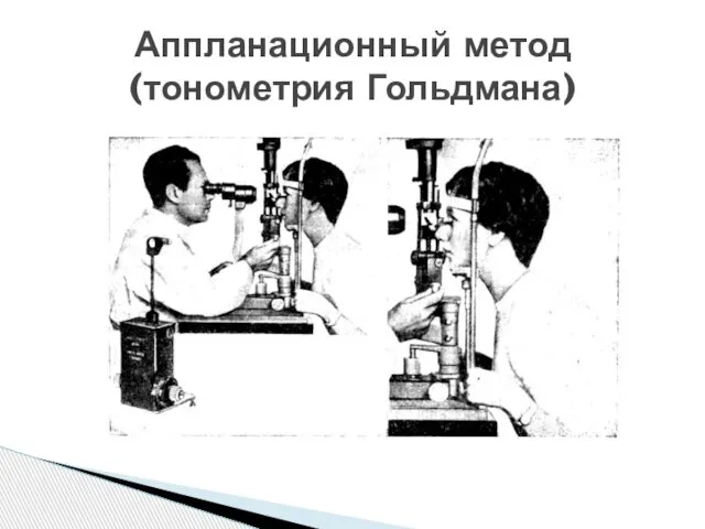 Аппланационный метод (тонометрия Гольдмана)