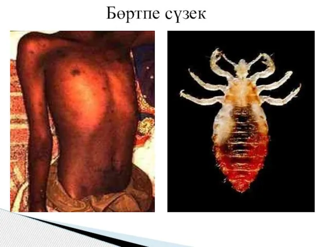 Бөртпе сүзек