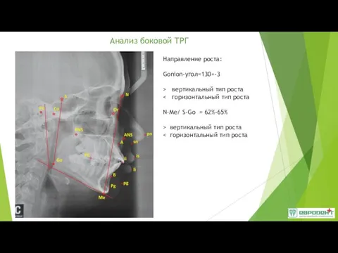 Анализ боковой ТРГ Направление роста: Gonion-угол=130+-3 > вертикальный тип роста N-Me/