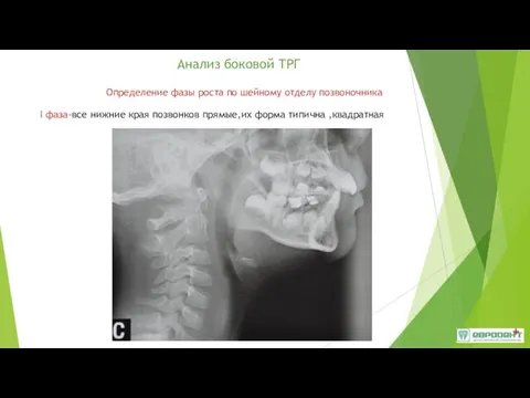 Анализ боковой ТРГ Определение фазы роста по шейному отделу позвоночника I