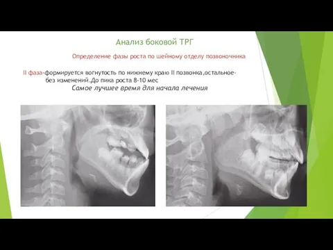 Анализ боковой ТРГ Определение фазы роста по шейному отделу позвоночника II