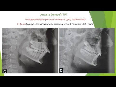 Анализ боковой ТРГ Определение фазы роста по шейному отделу позвоночника III