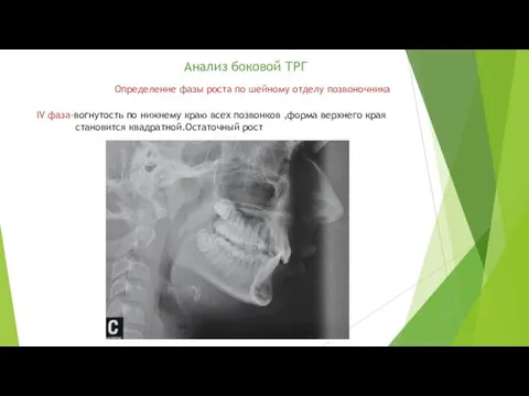 Анализ боковой ТРГ Определение фазы роста по шейному отделу позвоночника IV
