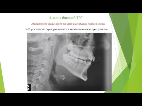 Анализ боковой ТРГ Определение фазы роста по шейному отделу позвоночника V-VI-рост отсутствует,уменьшается межпозвоночное пространство