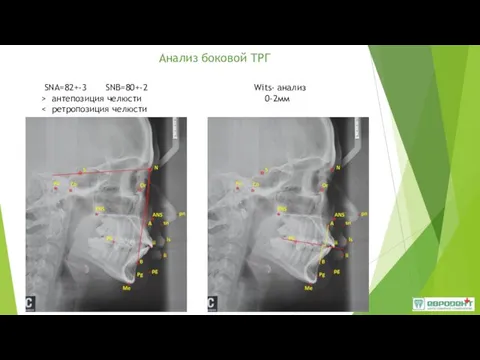 Анализ боковой ТРГ SNA=82+-3 SNB=80+-2 > антепозиция челюсти Wits- анализ 0-2мм