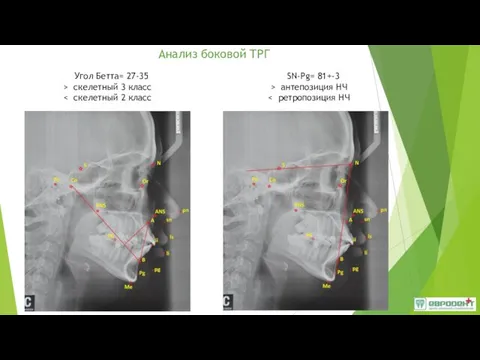 Анализ боковой ТРГ Угол Бетта= 27-35 > скелетный 3 класс SN-Pg= 81+-3 > антепозиция НЧ