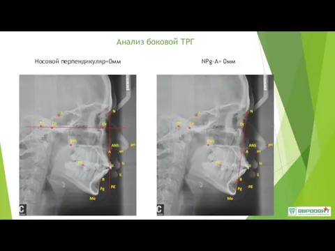 Анализ боковой ТРГ Носовой перпендикуляр=0мм NPg-А= 0мм