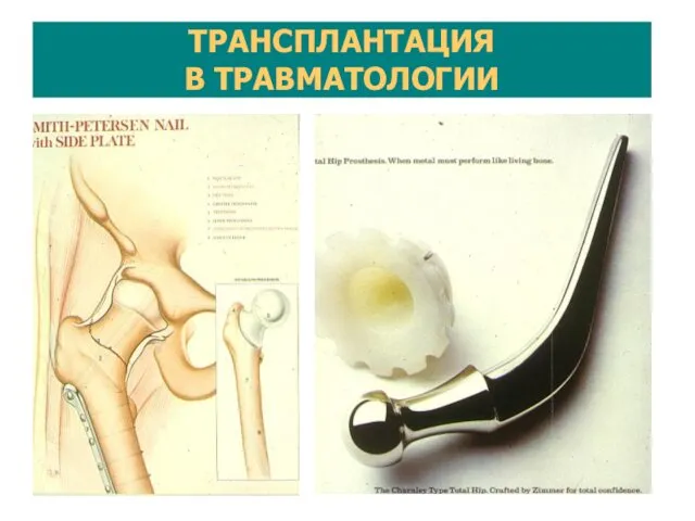 ТРАНСПЛАНТАЦИЯ В ТРАВМАТОЛОГИИ