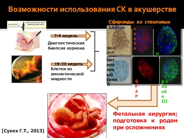 Возможности использования СК в акушерстве Диагностическая биопсия хориона Клетки из амниотической