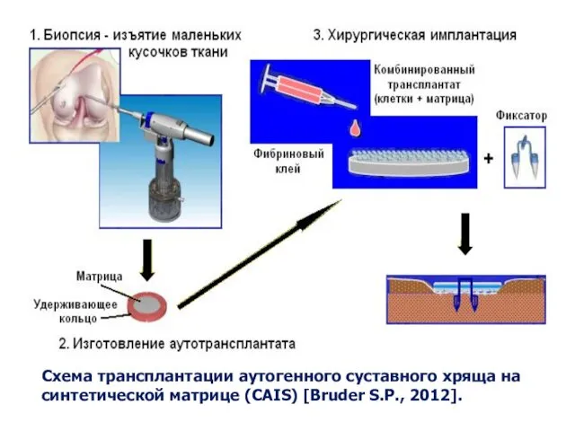 Схема трансплантации аутогенного суставного хряща на синтетической матрице (CAIS) [Bruder S.P., 2012].