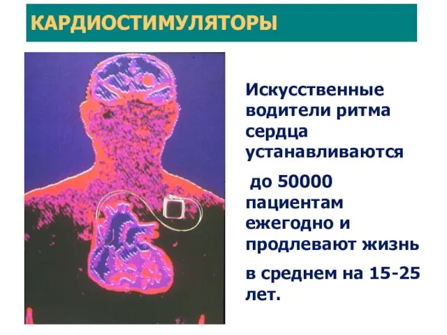 Искусственные водители ритма сердца устанавливаются до 50000 пациентам ежегодно и продлевают