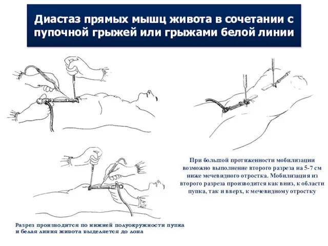 Диастаз прямых мышц живота в сочетании с пупочной грыжей или грыжами