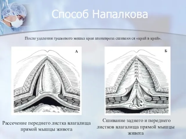 Способ Напалкова Рассечение переднего листка влагалища прямой мышцы живота Сшивание заднего