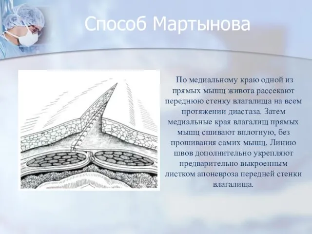 Способ Мартынова По медиальному краю одной из прямых мышц живота рассекают