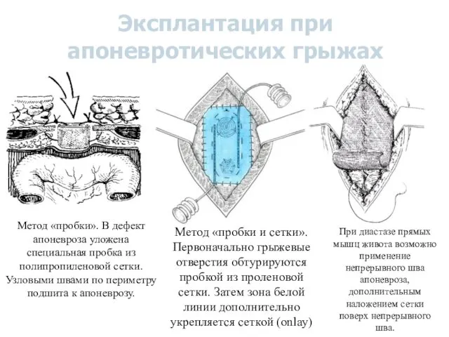 Эксплантация при апоневротических грыжах Метод «пробки». В дефект апоневроза уложена специальная