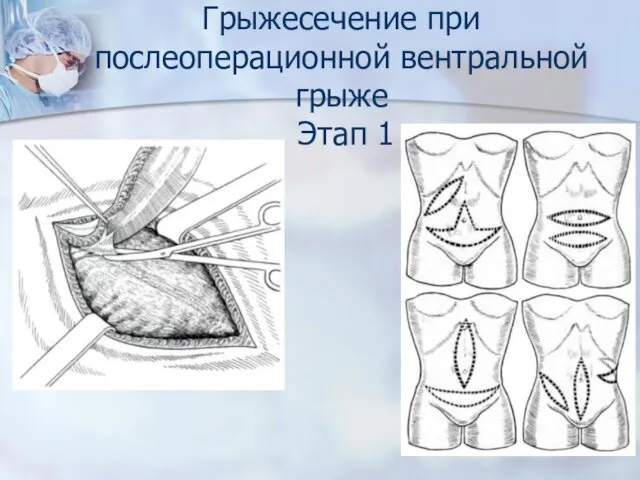 Грыжесечение при послеоперационной вентральной грыже Этап 1