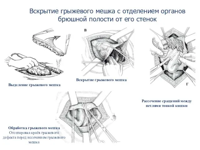 Вскрытие грыжевого мешка с отделением органов брюшной полости от его стенок