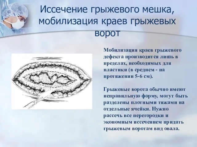 Иссечение грыжевого мешка, мобилизация краев грыжевых ворот Мобилизация краев грыжевого дефекта