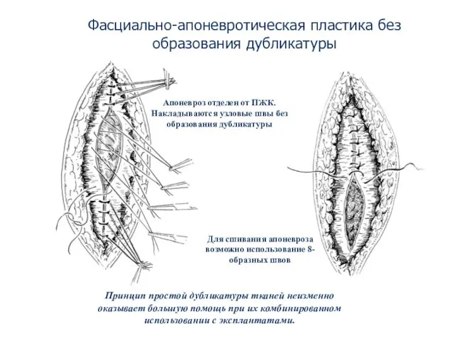 Фасциально-апоневротическая пластика без образования дубликатуры Апоневроз отделен от ПЖК. Накладываются узловые