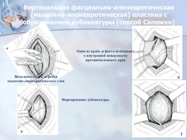 Вертикальная фасциально-апоневротическая (мышечно-апоневротическая) пластика с образованием дубликатуры (способ Сапежко) Один из